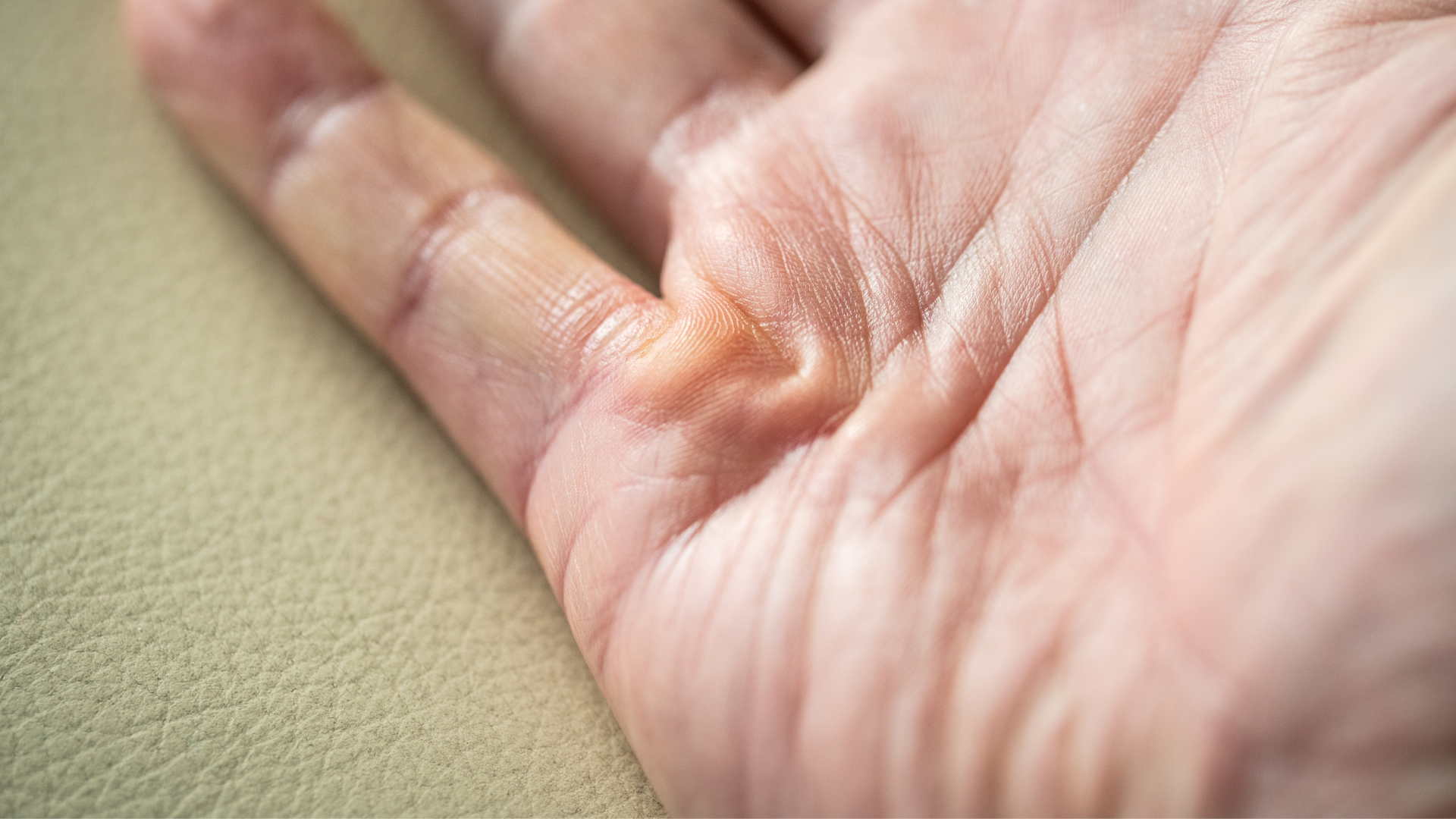 Dupuytren's Contracture